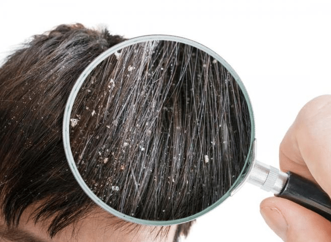 أسباب قشرة الشعر وكيفية علاجها