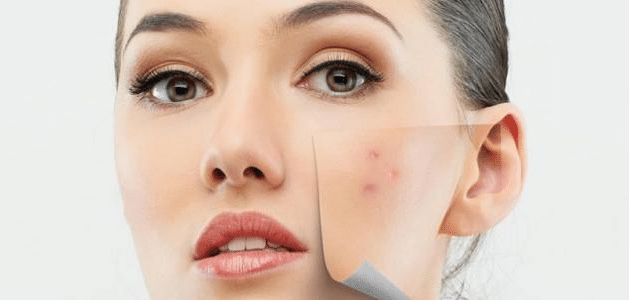 علاج حبوب الوجه