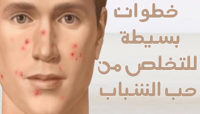 طرق التخلص من حب الشباب