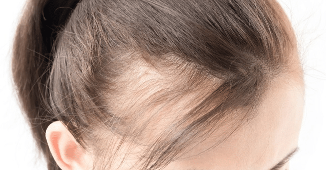 علاج تساقط الشعر بسبب نقص الحديد