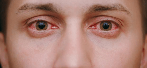 طرق علاج المشاكل التي تصيب العين