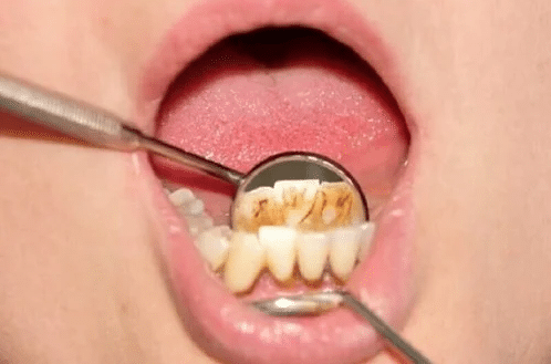 تعرف على طرق التخلص من البقع البنية على الأسنان