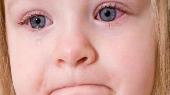 حساسية العين للاطفال