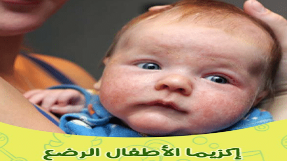 علاج الاكزيما عند الرضع