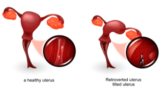 هل الرحم المقلوب يمنع الحمل