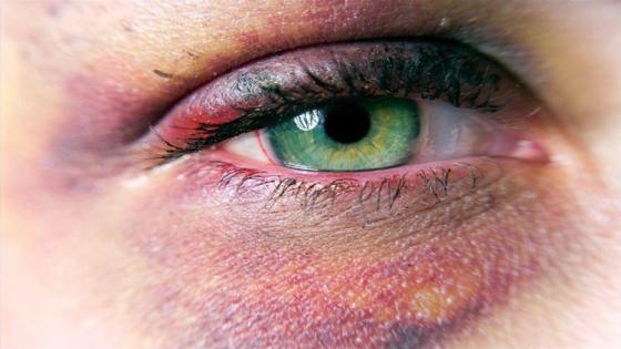 أنواع الإصابات في العين وكيفية التعامل معها