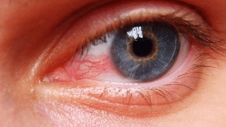 أسباب إحمرار العيون عند الأطفال