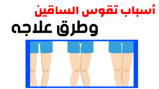 أسباب تقوس الساقين عند الأطفال وطرق علاجه