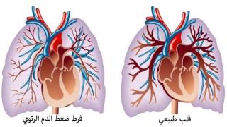 ارتفاع ضغط الدم الرئوي