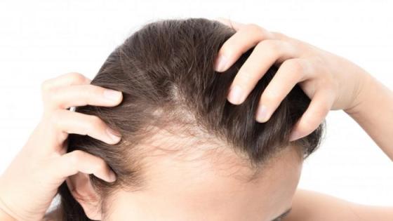 علاقة تساقط الشعر بأمراض الغدة الدرقية