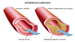 الكولسترول (Cholesterol)