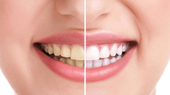 تعرف على طرق التخلص من البقع البنية على الأسنان